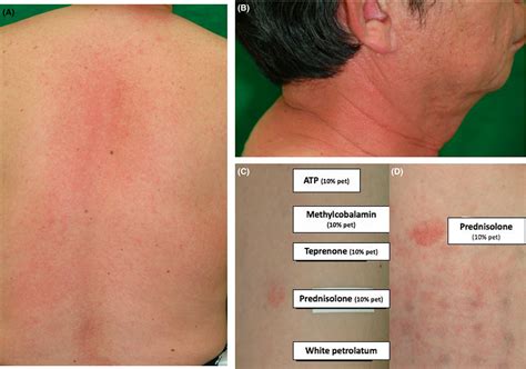 medrol for skin allergy testing